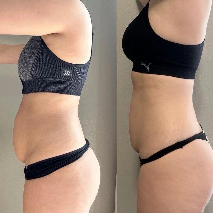 Endospheres Bauch vorher und nachher