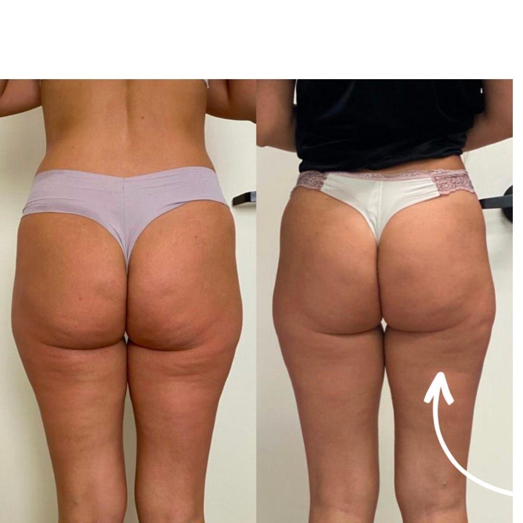 Endospheres Po-Lifting vorher und nachher
