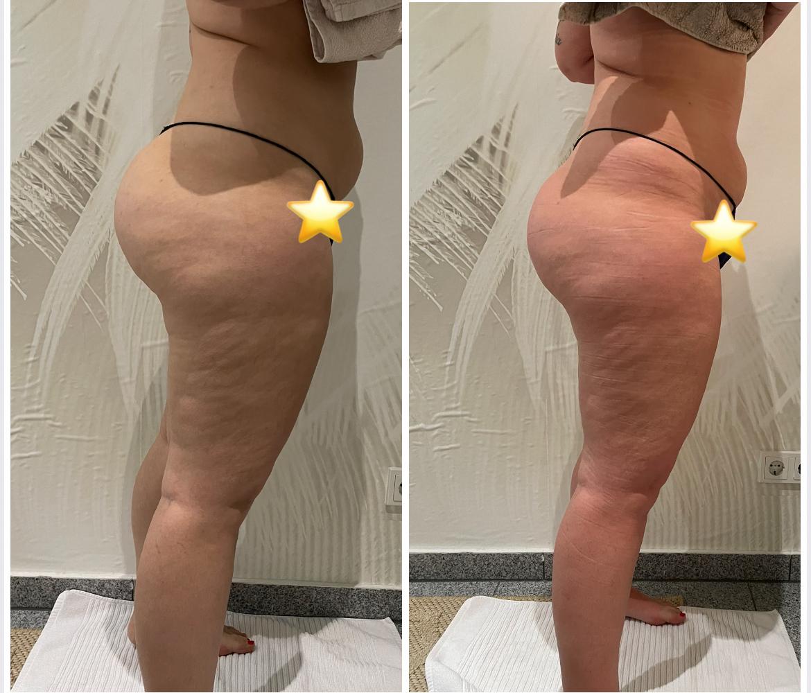 Endospheres Oberschenkel Cellulite vorher und nachher